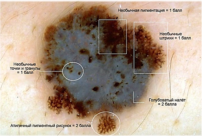 диагностика меланомы по 7 признакам