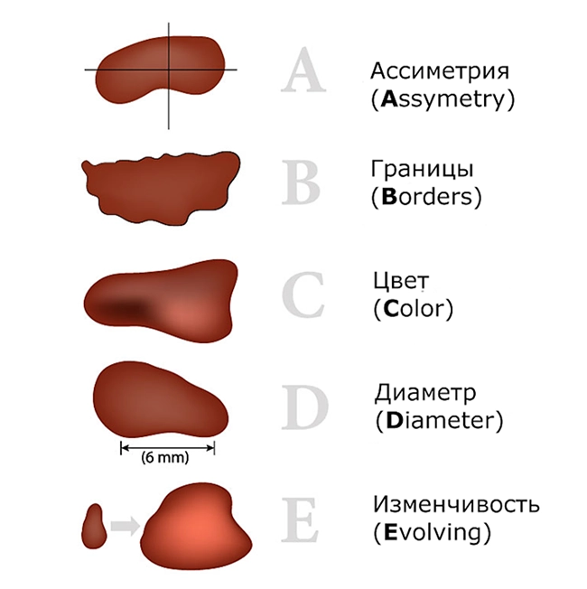 abcde признаки