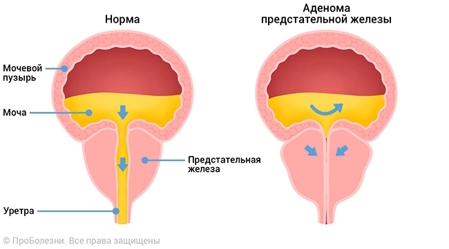 Аденома простаты1