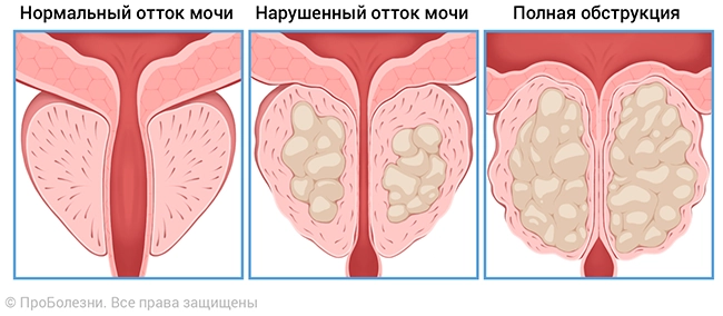 Аденома простаты2