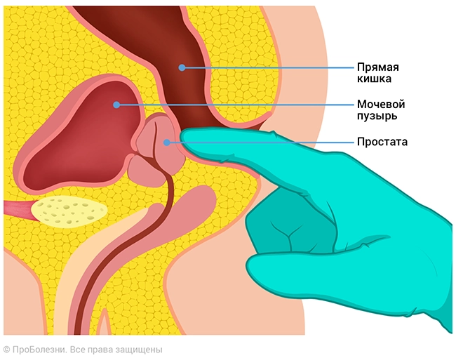 Аденома простаты3