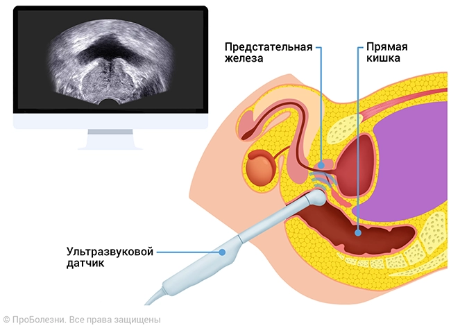 Аденома простаты4