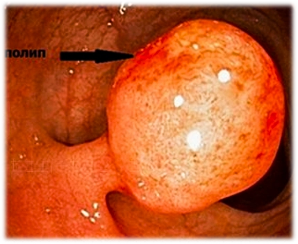 аденоматозный полип желудка на ножке