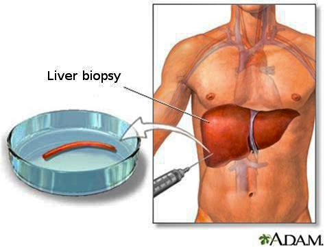 biopsiya-pecheni_s