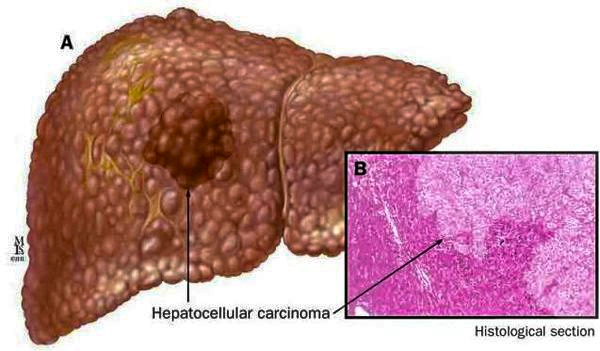 gepatocellyulyarnaya-karcinoma_s