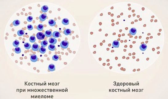 костный мозг при миеломе