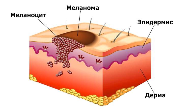 меланома