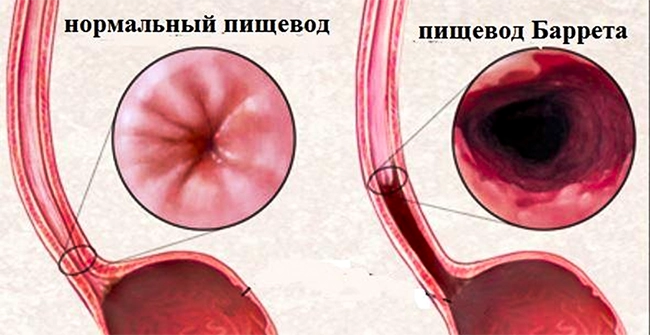 пищевод Баррета