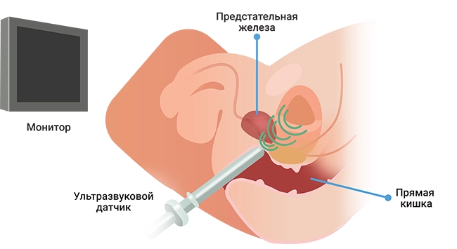 простатит 7