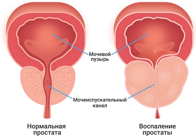 простатит1