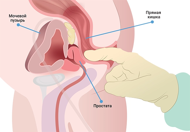 простатит6