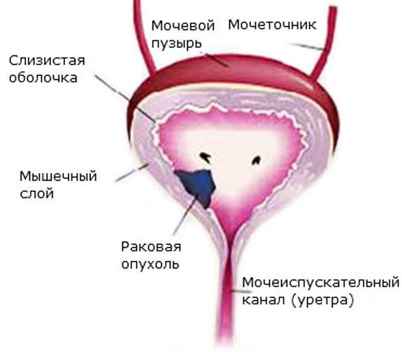 рак мочевого пузыря