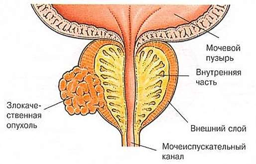 рак простаты