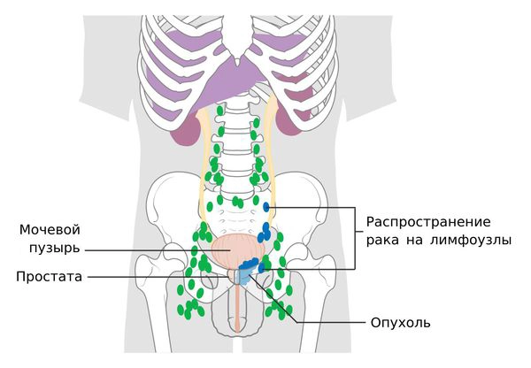 рак простаты5