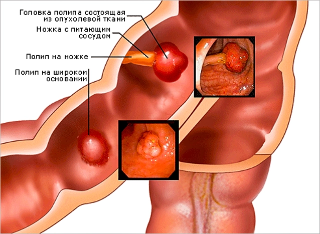 семейный аденоматоз толстой кишки