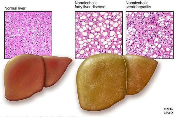 uvelichenie-gepatocitov-i-narushenie-funkcii-pecheni_s 