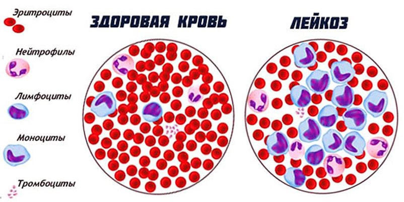 здоровая кровь, лейкоз копия