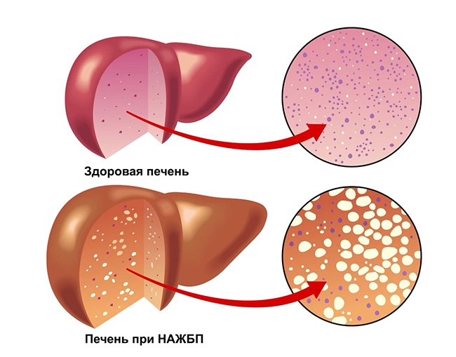 жировой гепатоз1