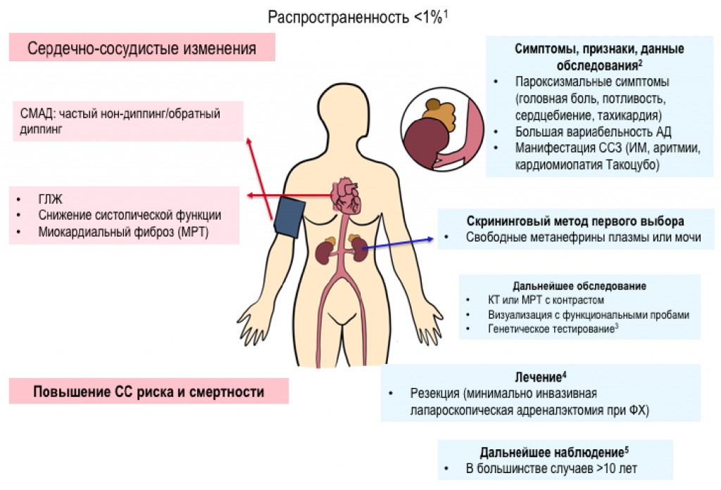 феохромацитома параганглиома