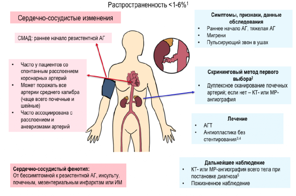 фибромускулярная дисплазия