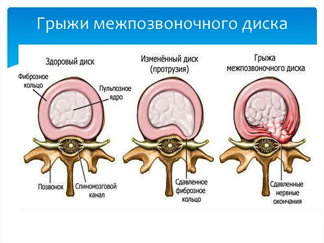 грыжи межпозвоночного диска