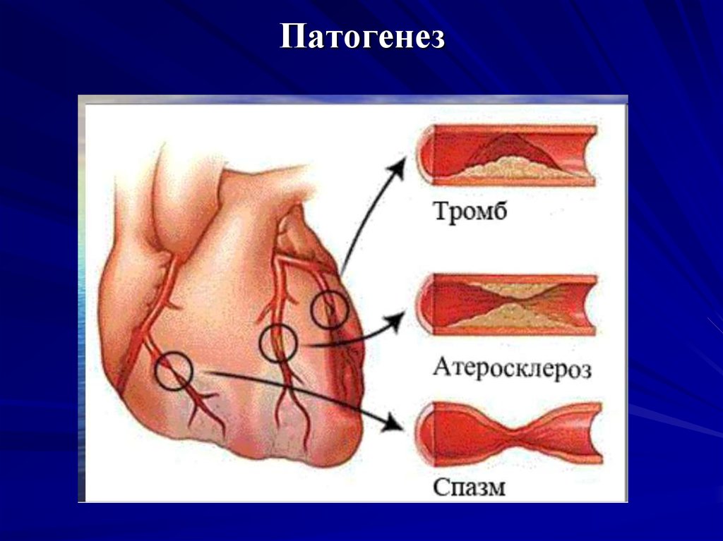 ибс патогенез