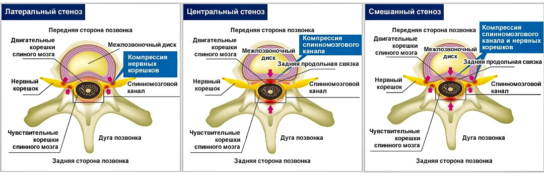 Классификации стеноза позвоночного канала