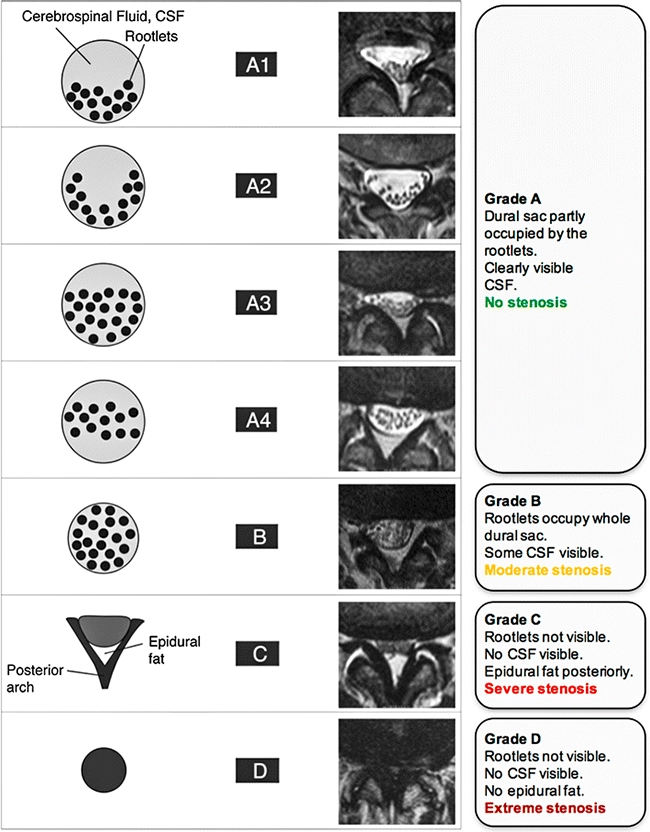 Классификация стенозов позвоночного канала по данным МРТ