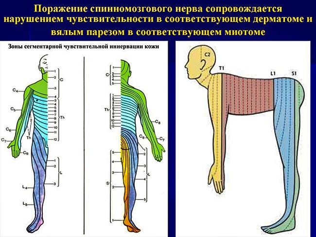 поражение спиномозгового нерва