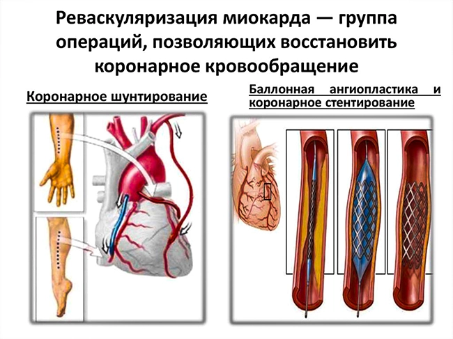 реваскуляризация миокарда