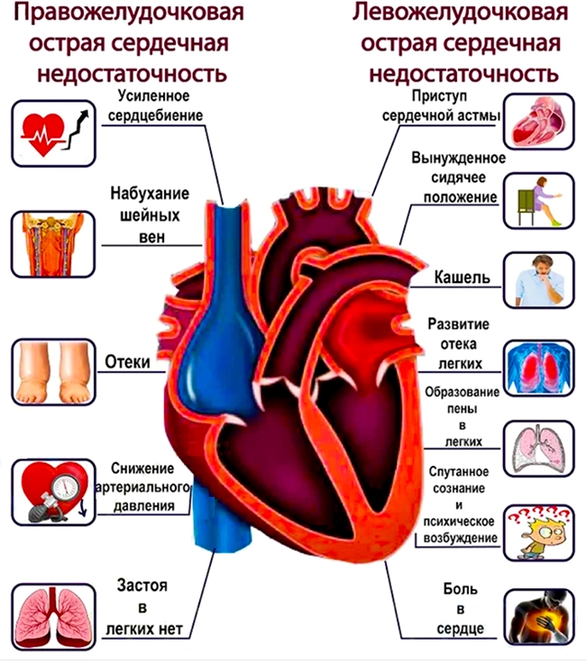 сердечная недостаточность