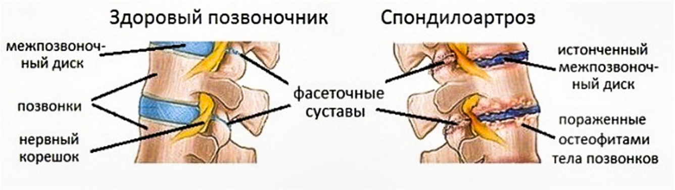 спондилоартроз