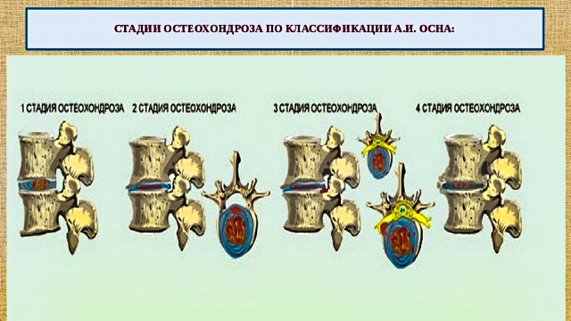 стадии осна