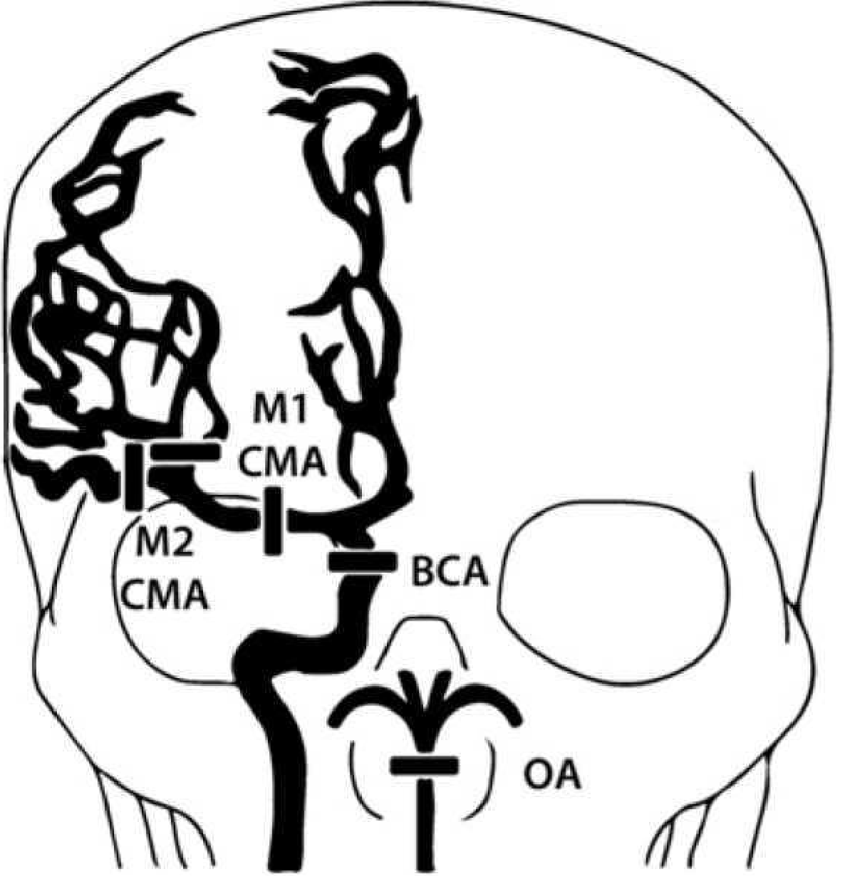 Шкала Alberta stroke Program early CT score1