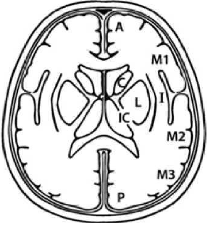 Шкала Alberta stroke Program early CT score2