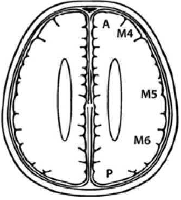 Шкала Alberta stroke Program early CT score3